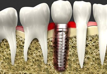Infected dental implant